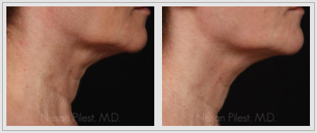 ematrix neck tightening before and after