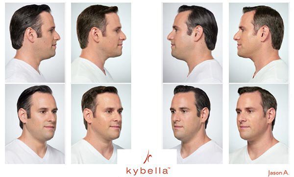 Kybella Before and After Male