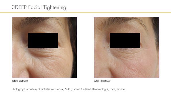 Irvine under eye wrinkle treatment before and after single treatment