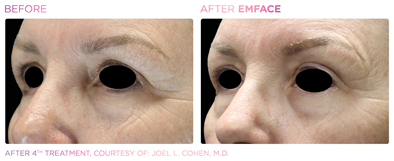 Irvine EmFace patient before and after
