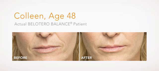Irvine Belotero Before and After 48 Yr Old Patient