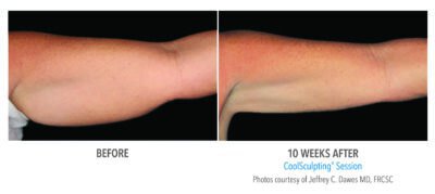 Irvine Coolsculpting for Arms Before and After Arms