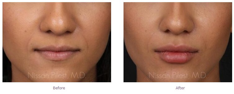 Irvine kiss tell juvederm lips model before and after