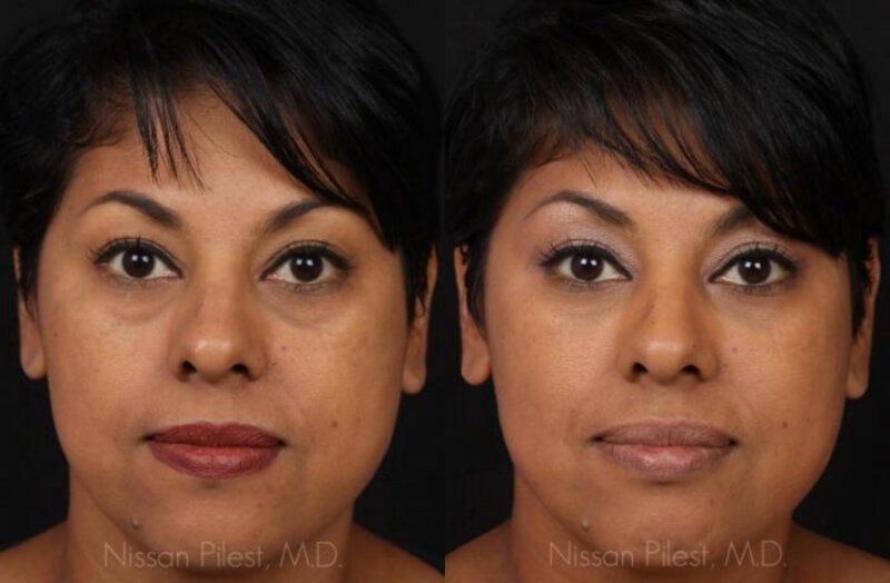 Restylane Before & After Irvine, CA