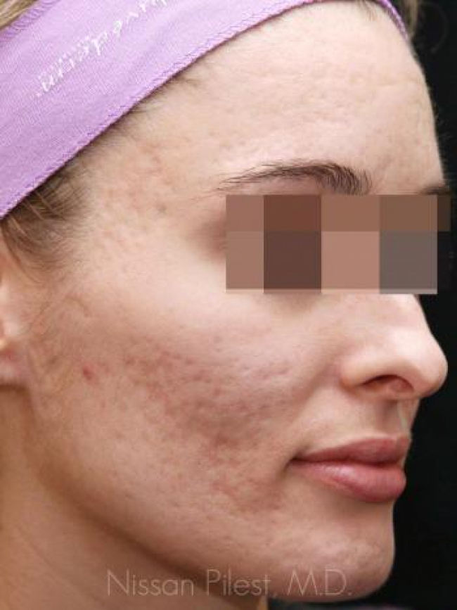Acne Before & After Image