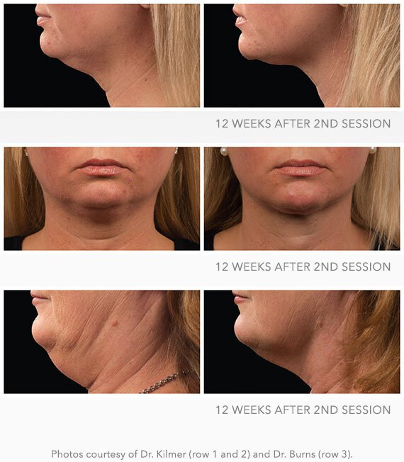 CoolSculpting for double chin before and after photos