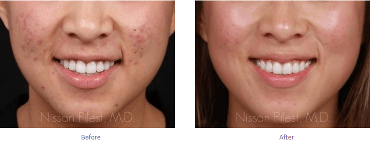 acne scarring treatment before and after