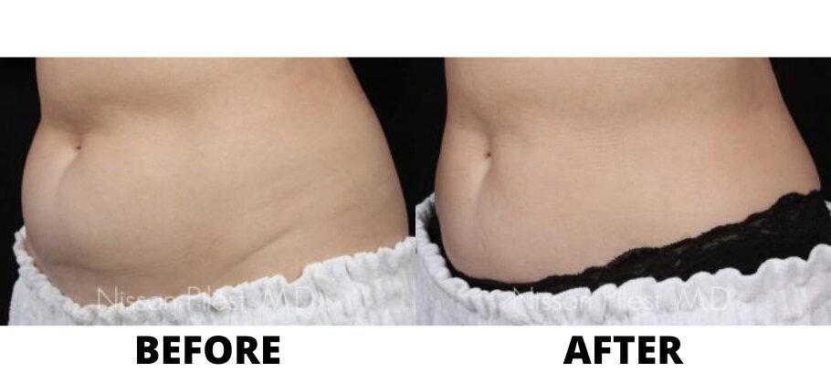 B & A Irvine Body Sculpting