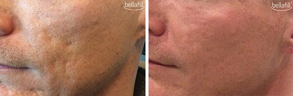 Bellafill Acne Scar Treatment Before & After Irvine, CA
