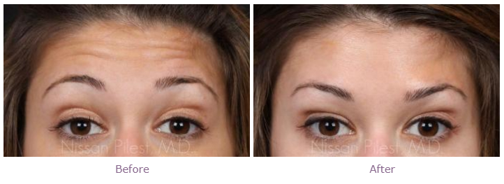 Botox-before-after