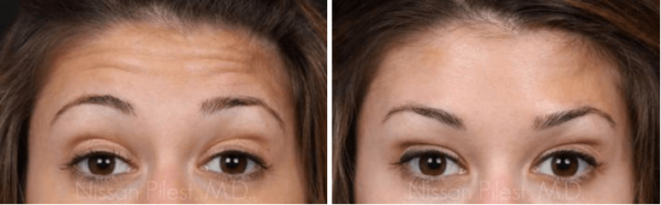 Botox Injections Irvine