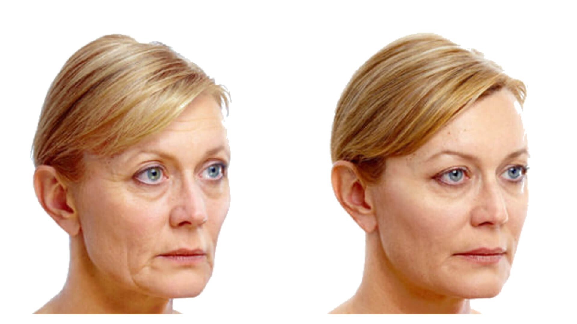 Botox-Irvine-CA