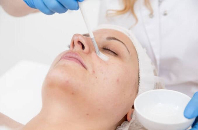 Chemical Peels Irvine