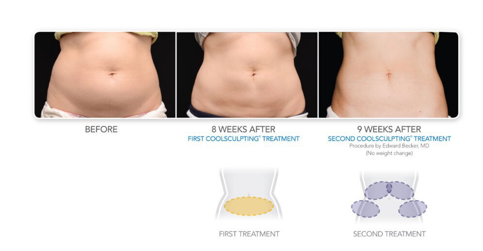Coolsculpting abdomen and hips for female