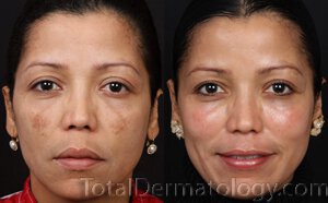 cosmelan before and after irvine dermatology clinic