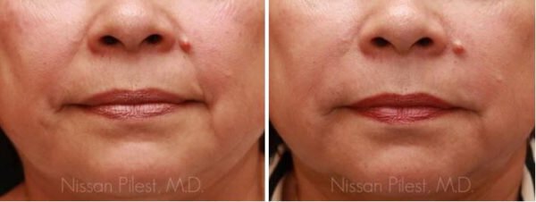 Dermal Fillers Irvine