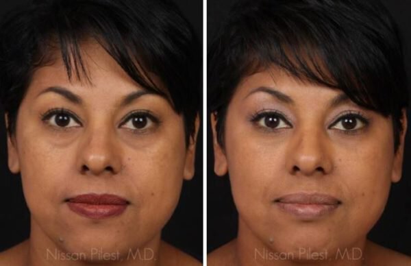 How To Treat Facial Volume Loss Without Surgery Total Dermatology