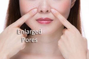 treatment for enlarged pores