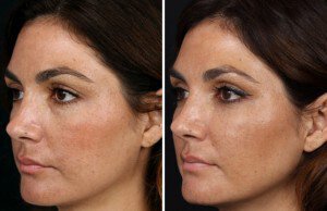 Fillers used under the eye and in the mid-face