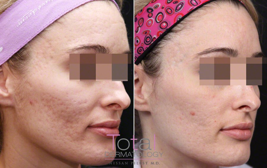 Acne scars removal with Fraxel before after photo Orange County