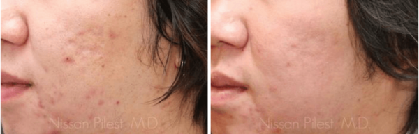 Fraxel Laser Skin Resurfacing Irvine