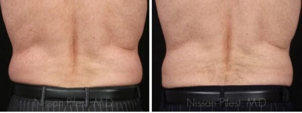 Irvine Body Contouring