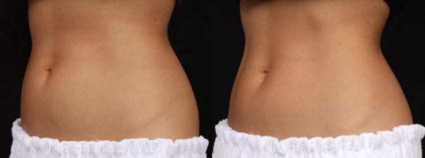 Irvine Coolsculpting