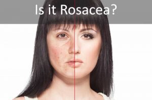 Is it Rosacea