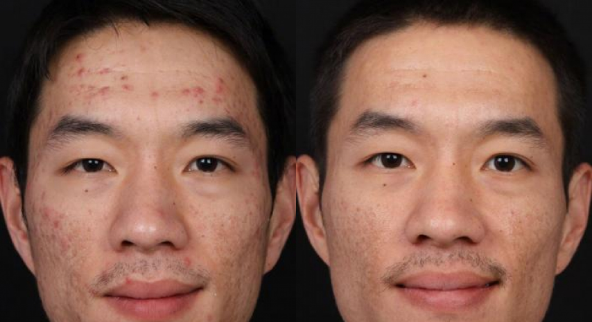 Isolaz Acne Laser Before & After Irvine, CA
