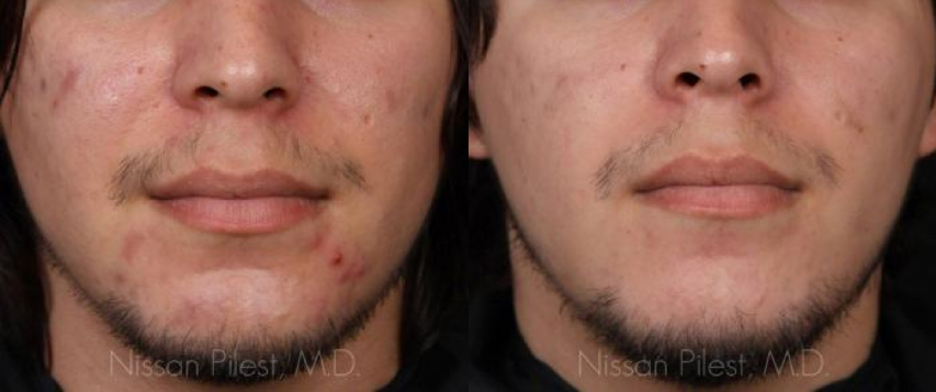 Isolaz Acne Laser Before & After Irvine, CA