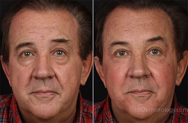 botox and fillers for men orange county