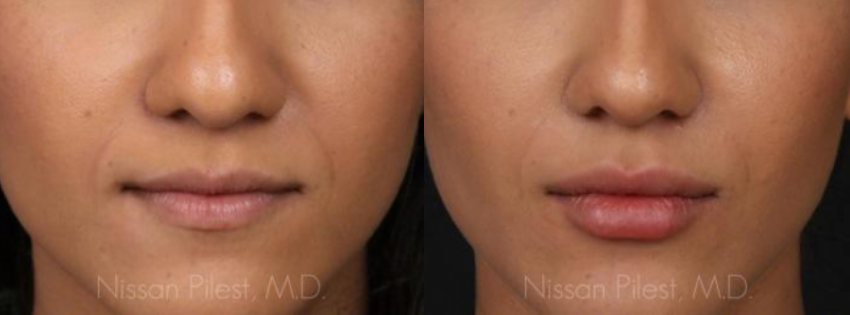 Juvederm Irvine