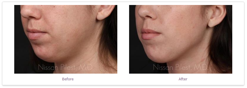 kybella before and after