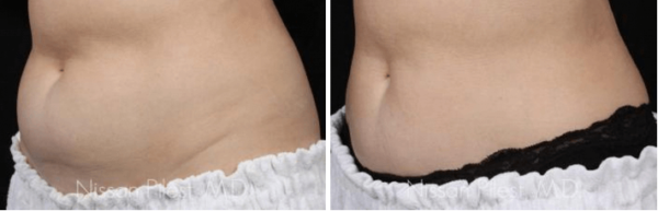 Lower Abdomen CoolSculpting Irvine