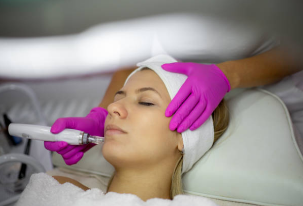 Microneedling Irvine