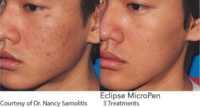 Micro Needling Acne Scars