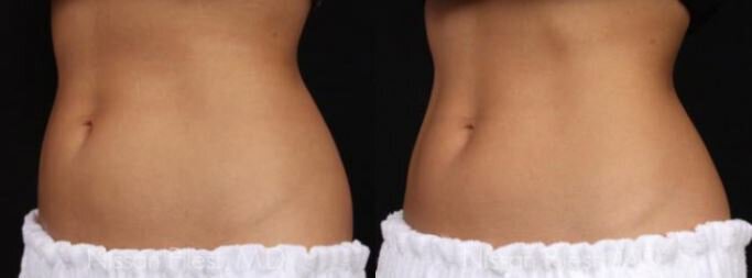 non-surgical fat reduction treatments Irvine