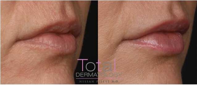 Non Surgical Lip Augmentation Irvine