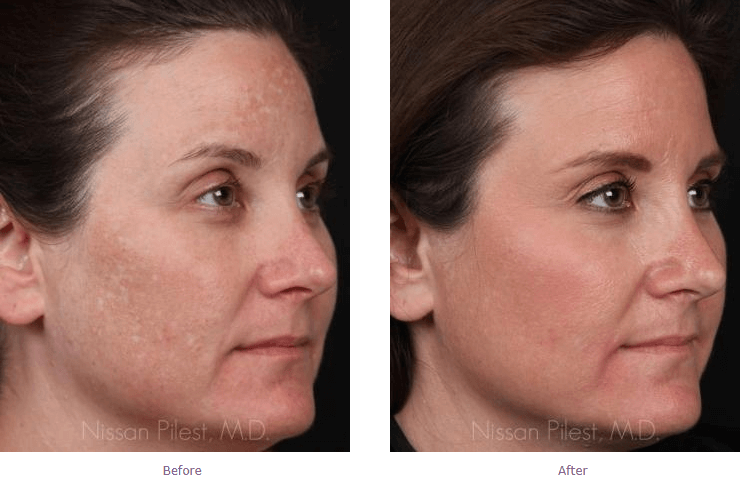 pigmentation treatment before and after