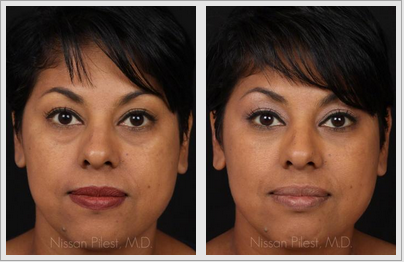 Restylane Before & After Photo