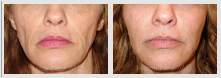 sculptra before and after