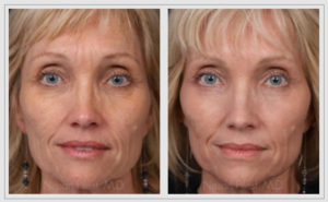 skin resurfacing before and after