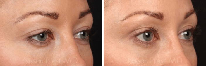 Thermage Eyelid Tightening Irvine