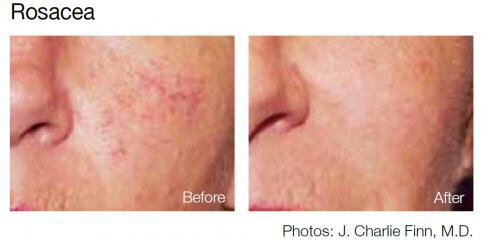 rosacea treatment before and after