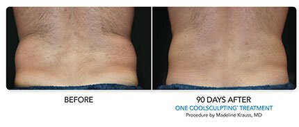 Irvine Fat Freezing For Men Before & After