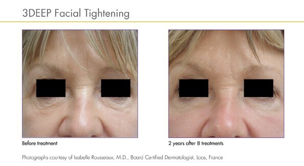 Facial tightening Endymed before and after