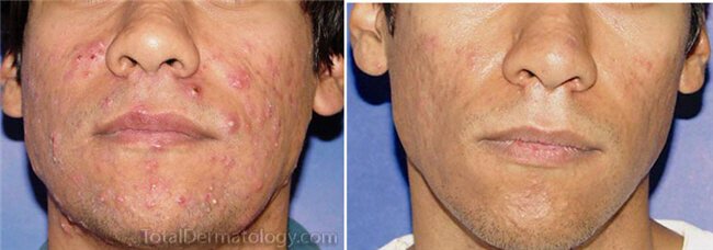 Irvine acne treatment patient nissan-pilest