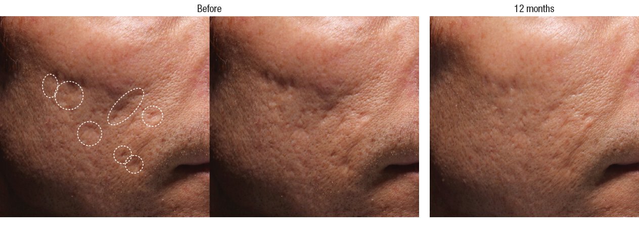 Bellafill Acne Scar Treatment Before And Afters Total Dermatology