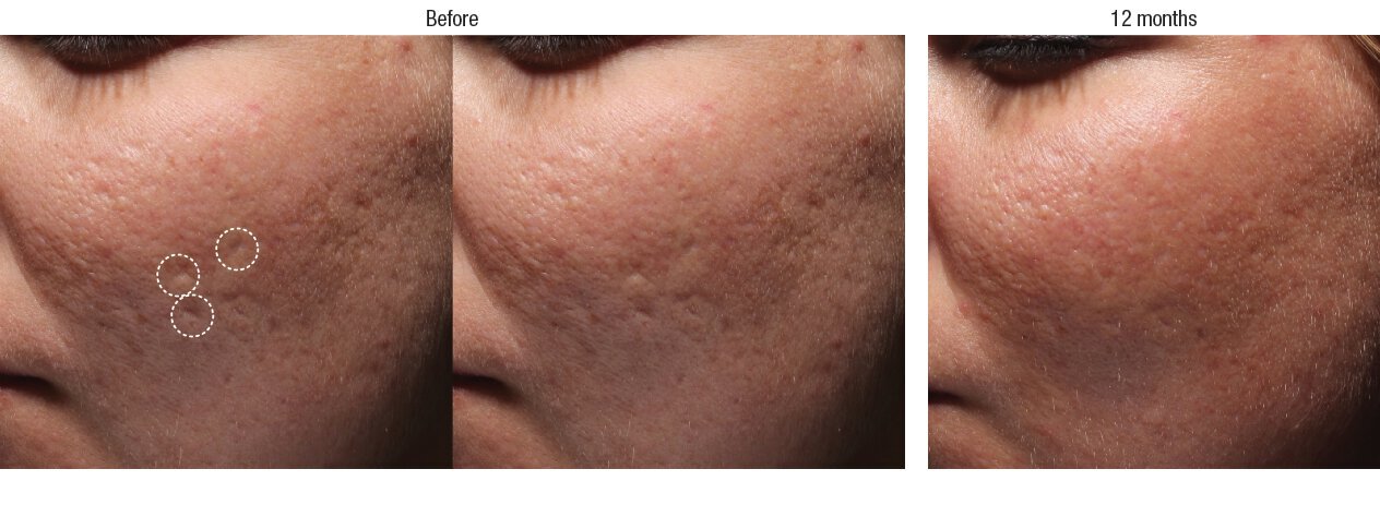 Bellafill Acne Scar Filler Photoset 5