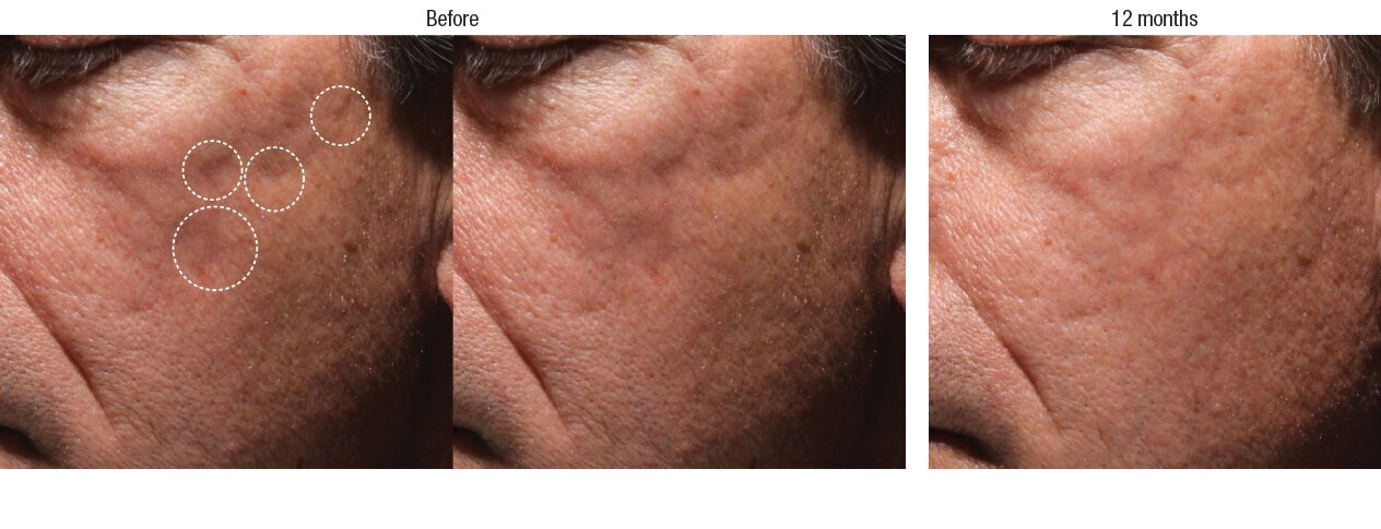 Bellafill Acne Scar Filler Photoset 5